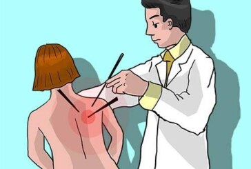Неосторожное иглоукалывание привело к проколу легкого