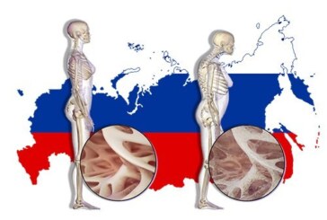 1 перелом в 3 минуты. Последствия остеопороза в России станут тяжелее, если не принять меры